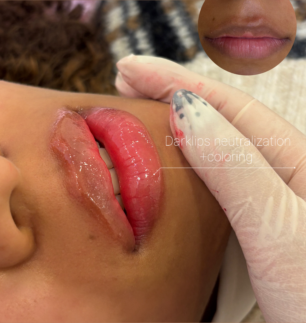 Darklips Neutralization + Coloring